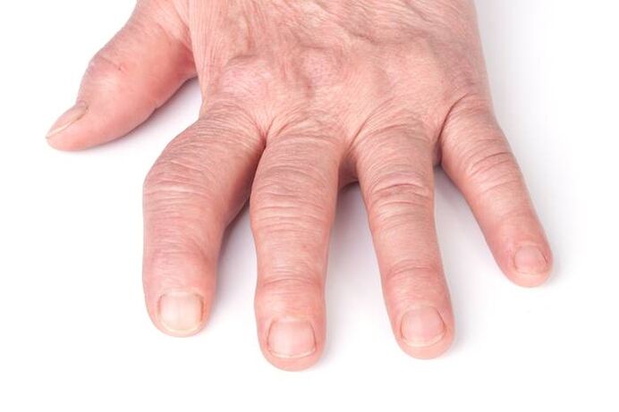 arthrose déformante sur les mains