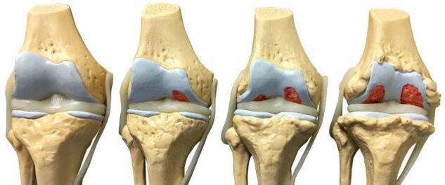 Dommages articulaires à divers stades du développement de l'arthrose de la cheville