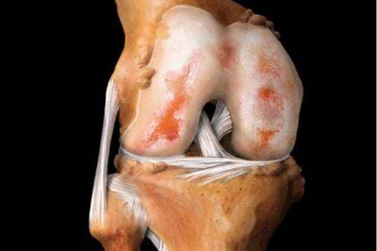 Dommages à l'articulation du genou avec l'arthrose