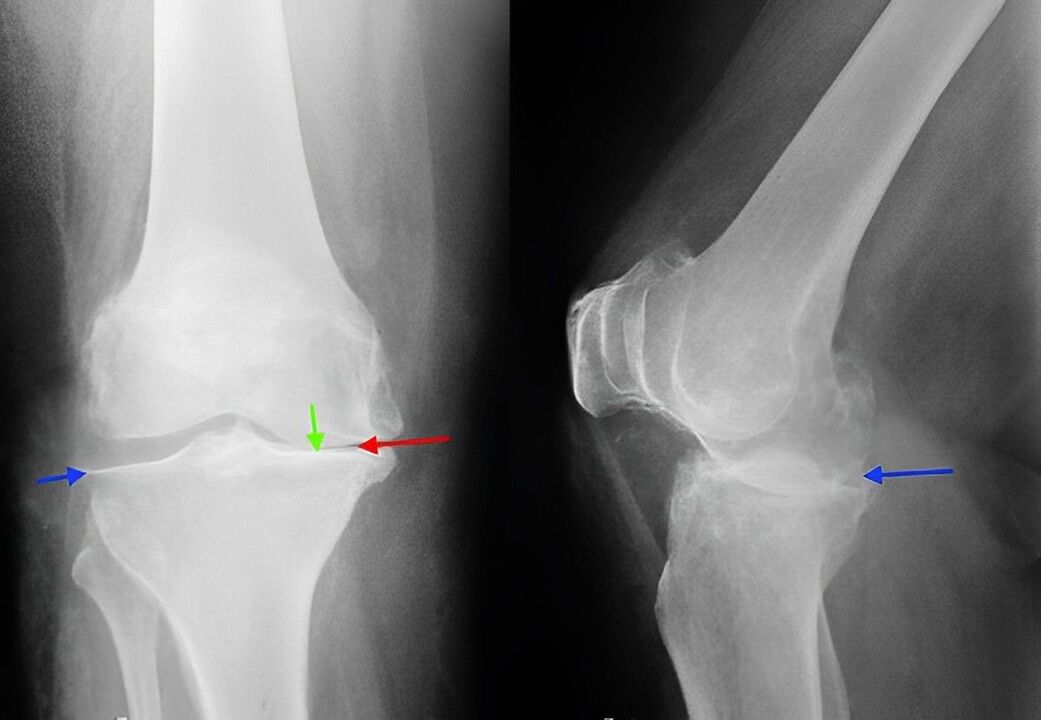 Image radiographique de l'arthrose de l'articulation du genou