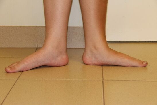 Parfois, les pieds plats sont à l’origine de l’arthrose du cou