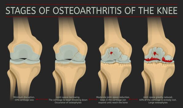 Développement de l'arthrose articulaire