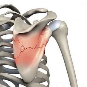 Une fracture de l'omoplate est l'une des causes de douleurs intenses.
