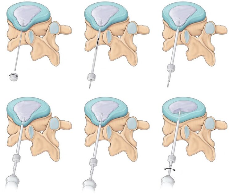 Chirurgie pour les maux de dos