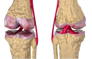Les varices sont à l'origine du développement de la gonarthrose
