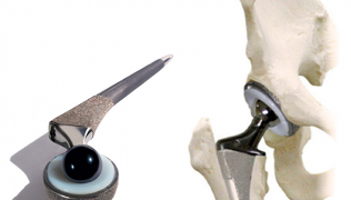 Endoprothèses de l'articulation de la hanche dans l'arthrose