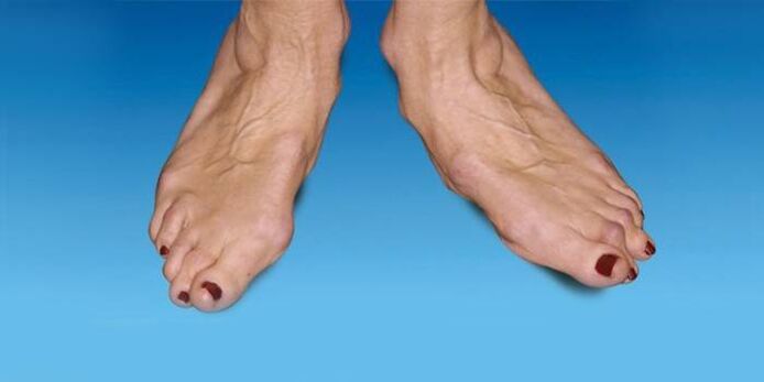 Malposition du pied dans l'arthrose de la cheville