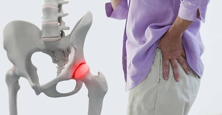 Douleur à la hanche - un symptôme d'arthrose de l'articulation de la hanche