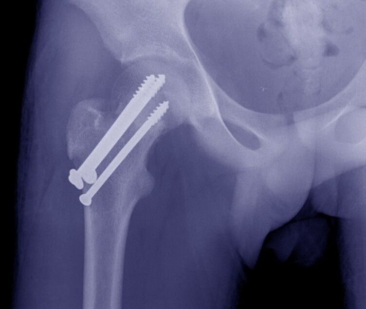 Radiographie de l'articulation de la hanche, ostéosynthèse de la fracture avec fixateurs internes